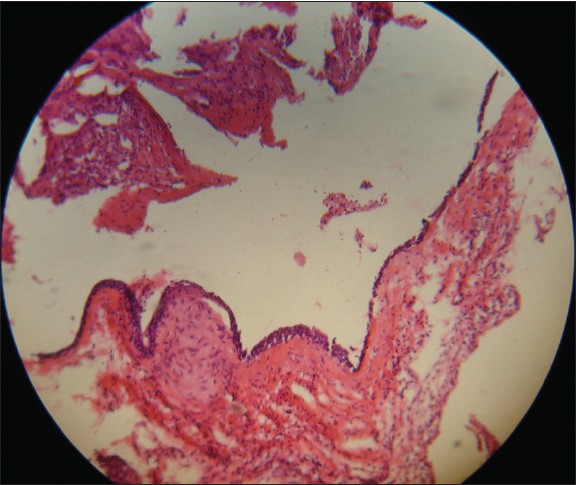 Figure 9: Another histopathological section showing the cystic epithelial lining typically of dentigerous cyst