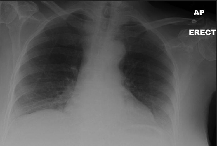 Figure 1: An erect chest radiograph: No evidence of air beneath the diaphragm