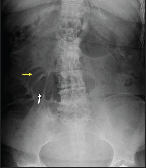 Figure 2: Abdominal radiograph: Central, dilated loops of small bowel (white arrow). Note the plicae circulares or valvulae conniventes (yellow arrow), a feature of small bowel, which confirms that the dilated structure is small bowel. Some loops measure 64 mm in diameter. There is no gas within the large bowel suggesting a complete or nearly complete mechanical small bowel obstruction