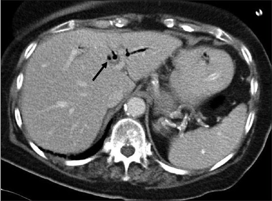 Figure 3: Axial CT image of the upper abdomen: There is diffuse pneumobilia (black arrow)
