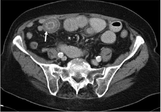 Figure 4: Axial CT image of the pelvis: There is a calculus (white arrow) identified within the small bowel lumen. Note the presence of both dilated and non‑dilated small bowel