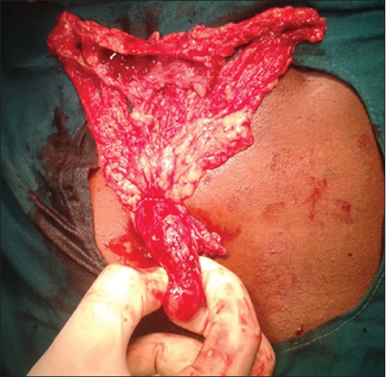 Figure 1: Intraoperative photograph of inflamed appendix with mass
