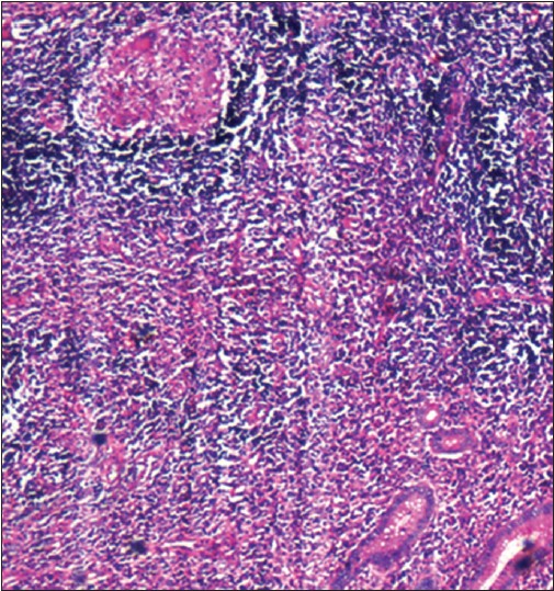 Figure 2: Histopathology showing epithelioid granuloma with langhans giant cells and neutrophilic infiltrate in the lumen of appendix (x4 magnification)