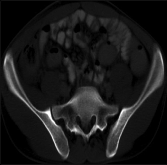 Figure 4: CT photograph showing normal abdomen