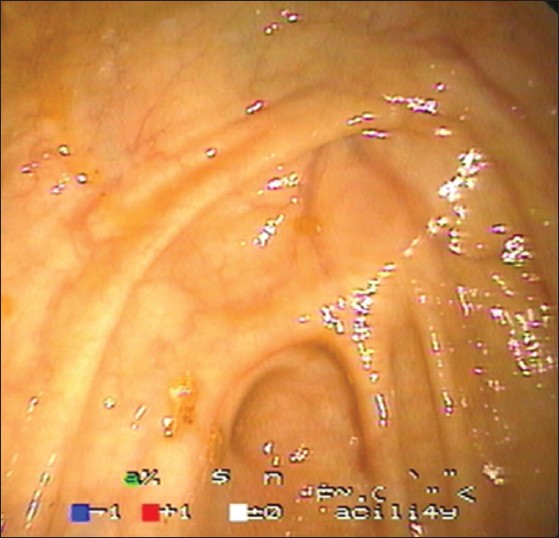 Figure 6: Colonoscopy photo showing normal caecum