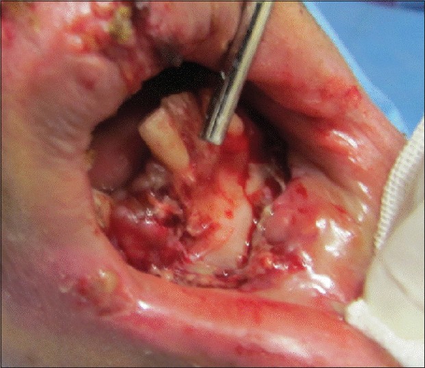 Figure 1: Complete mandibular degloving injury exposing mandibular bone from marginal bone to inferior border