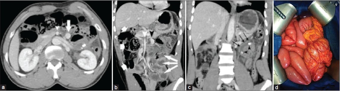 Figure 1: (a) Portal-venous phase computed tomography (CT) image. Superior mesenteric vein (arrow) is on the left side of the superior mesenteric artery (arrowhead); (b) Coronal multiplanar reformation (MPR) from portal-venous phase CT demonstrates a midgut malrotation. Superior mesenteric vein (black arrowhead) is on the left side of the superior mesenteric artery (white arrowhead). The entire small bowel (thin arrows) is in the left half of the abdomen and colon (thick arrows) is in the right half; (c) Coronal MPR from portal-venous phase CT demonstrates a acute upper left side appendicitis (arrows) with two stercoliths (arrowheads) and (d) Operative view with the entire small bowel in the right half of the abdomen and colon in the left half