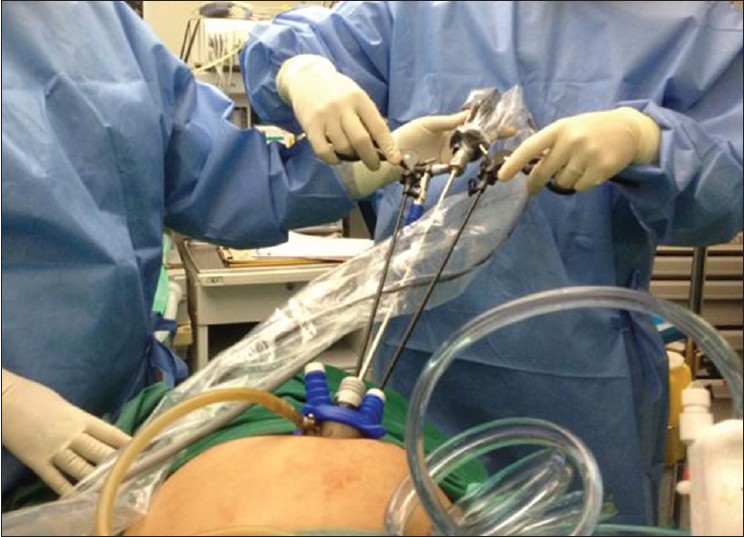 Figure 4: Combined use of prebent and straight forceps through X-cone single port system