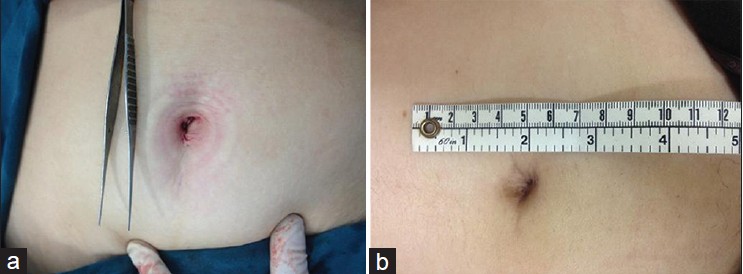 Figure 5: (a) Umbilical scar immediately after the surgery and (b) 8-week after the surgery
