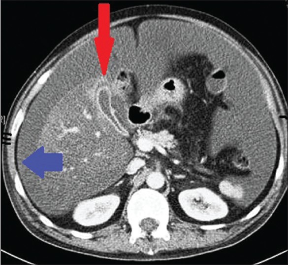 Figure 1: Computed tomography showing gallbladder fundus perforation (red arrow) and free intraperitoneal fluid (blue arrow)