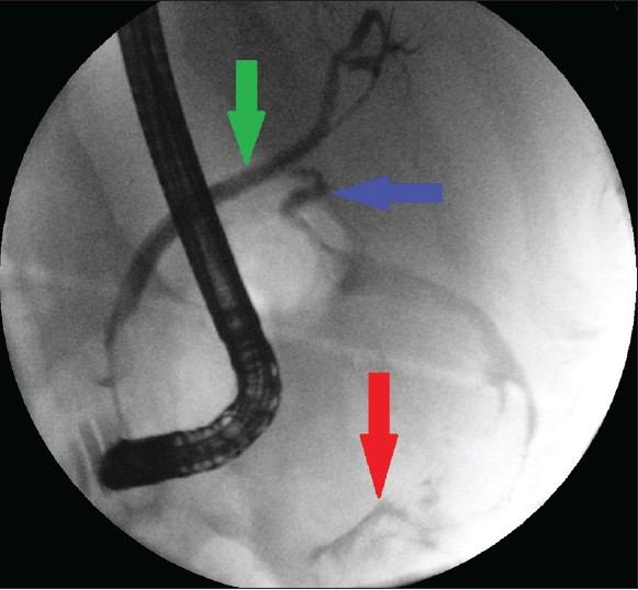 Figure 2: Endoscopic retrograde cholangio‑pancreatogram showing common bile duct (green arrow), cystic duct (blue arrow) and extravasation of contrast from perforated gallbladder (red arrow)