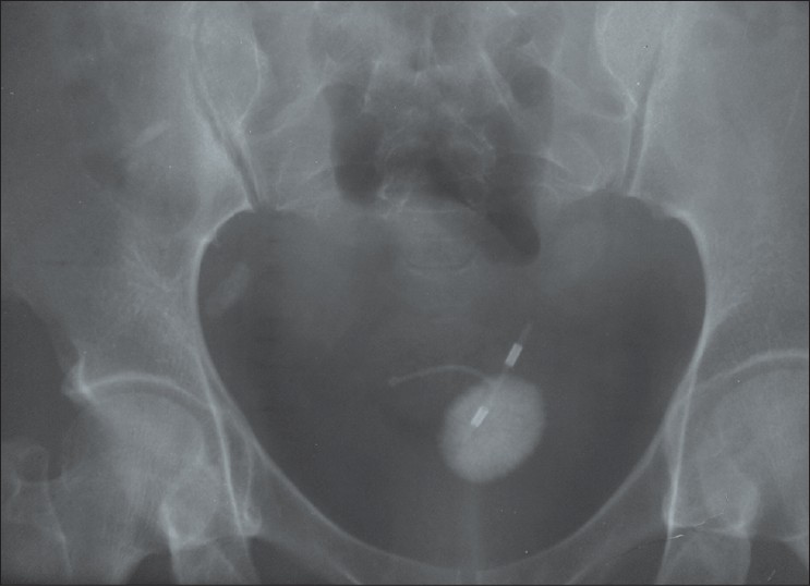 Figure 1: Pelvic X‑ray showing bladder stone with embedded Copper T intrauterine contraceptive device