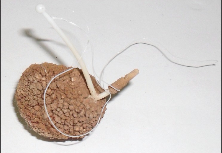 Figure 2: Extracted stone with intrauterine contraceptive device