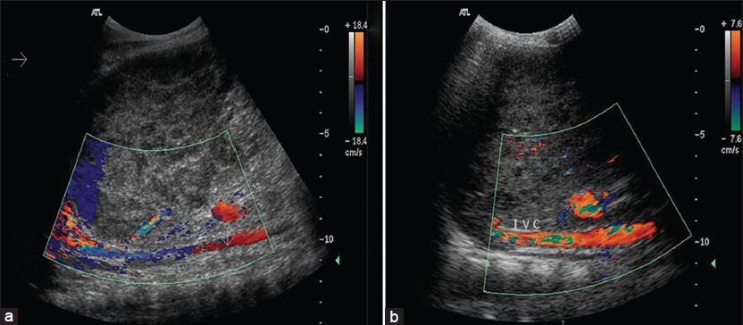 Figure 1: Ultrasound color Doppler examination; (a) Space occupying liver lesion compressing the infra hepatic part of inferior vena cava and (b) Smaller liver lesion with a patent inferior vena cava following surgical drainage