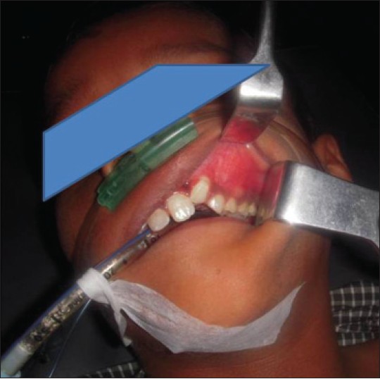 Figure 1: Pre-operative clinical picture showing swelling in the left maxillary anterior region
