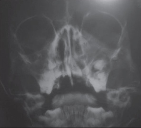 Figure 2: Paranasal sinus view showing well defi ned unilocular radiolucency surrounding the canine and supernumerary teeth