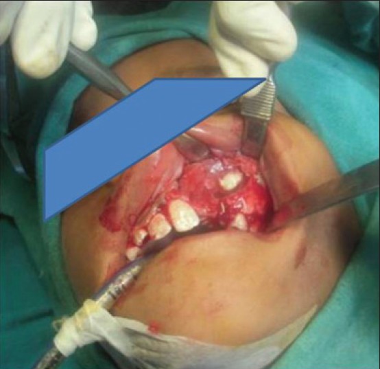 Figure 3: Surgical view of the cyst enclosing the impacted teeth
