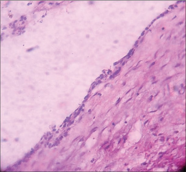 Figure 6: Histopathological image of the cystic lining showing features of dentigerous cyst