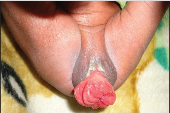 Figure 1: Uterovaginal prolapse at birth