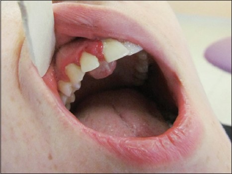 Figure 1: Exophytic mass in anterior maxilla, palatal to the dental arch with labial and interdental extension