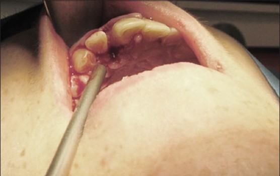Figure 2: The raw bone in interdental space and residual soft tissue defect in palatal and labial aspects