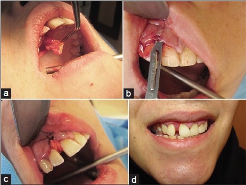Figure 3: (a) VIP-CT flap from the palate. (b) Supraperiosteal sharp dissection in labial region (pouch technique). (c) The flap was stabilized with 5-0 non resorbable sutures. (d) Healthy and esthetic gingiva four weeks after operation