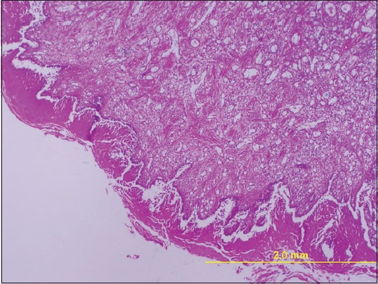 Figure 4: Histopathologic feature showing a proliferation of fibroblast with numerous of capillary