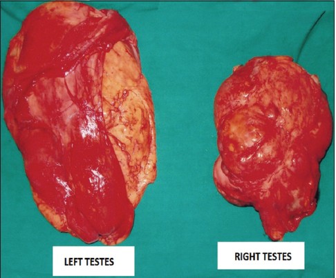 Figure 1: Gross specimen of the tumor mass measuring 20 x 14 x 5 cms on left and 16 x 14 x 4 cms on the right