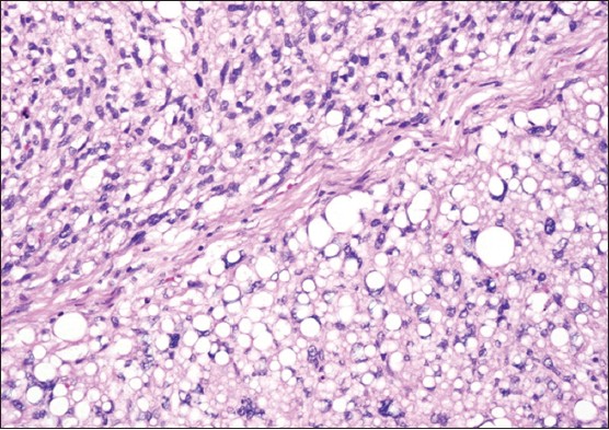 Figure 3: Microscopic examination of the mass revealed an encapsulated proliferation consisting of mature adipocytes accompanied by both spindle-shaped cells and multivacuolated lipoblasts