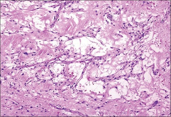 Figure 4: Microscopic photograph showing mature adipocytes, spindle-shaped cells with hyper chromatic nuclei within the stromal tissue and multivacuolated lipoblasts in between on a fibrous and myxoid background