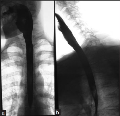 Figure 1: (a) Barium swallow post endoscopy (b) Barium swallow post endoscopy