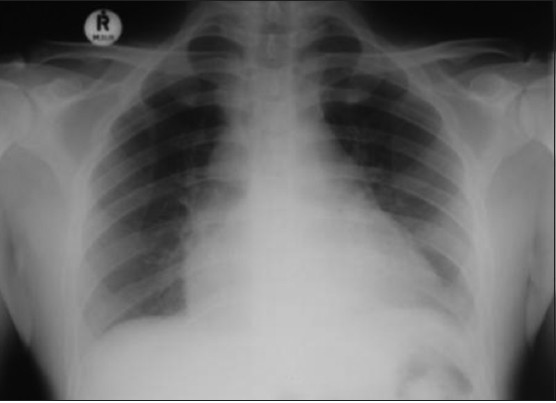 Figure 2: Chest radiograph post endoscopy