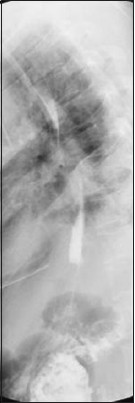 Figure 3: Barium swallow post pericardial drainage