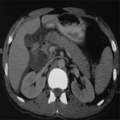 Figure 1: CECT abdomen showing laceration at the neck of the pancreas (arrow)