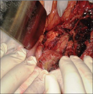 Figure 2: Intraoperative photograph showing laceration of the pancreas (arrow)