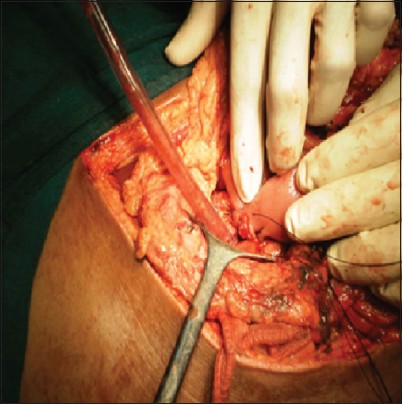 Figure 4: CECT abdomen showing laceration of the pancreas (arrow)
