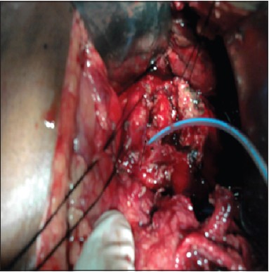 Figure 5: Intraoperative photograph showing lacerated pancreas. Pancreatic duct is shown cannulated with feeding tube