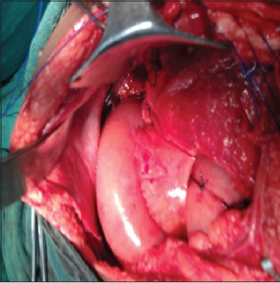 Figure 6: Anterior pancreatico-jejunostomy done at the lacerated site