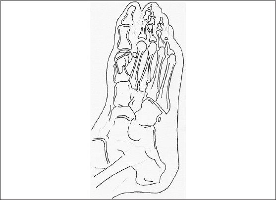 Figure 10: The proximal peg is shaped for firm placement into the metatarsal shaft and the graft is fixed with a 3.5 mm compression screw from medial proximal to distal lateral