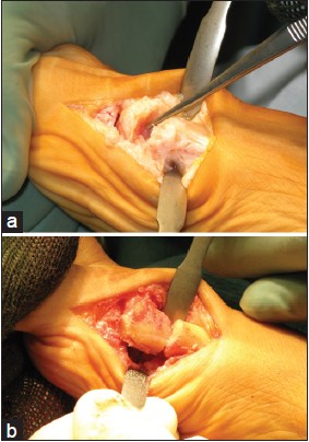 Figure 2: Intraoperative photographs: (a) Nonunion site (b) The proximal peg is inserted into the metatarsal shaft