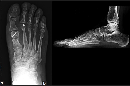 Figure 5: Plain radiographs: Weight-bearing (a) and Lateral (b) Views documenting graft viability