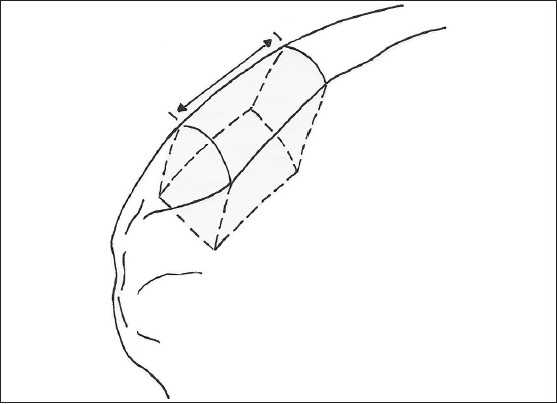 Figure 8: Tricortical autograft from ipsilateral iliac crest