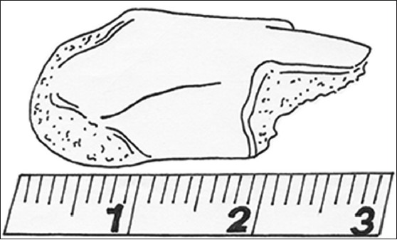 Figure 9: Round shape of the distal end of the graft