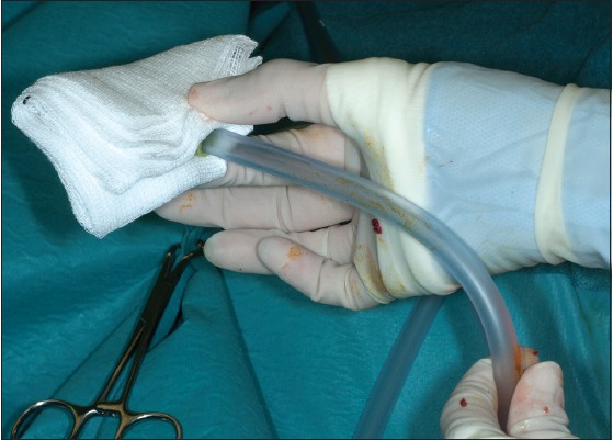 Figure 1: Remove any suction attachments e.g. Yankauer sucker and place a swab over the suction tubing
