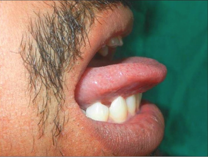 Figure 9: Tongue position after protrusion after 2 years (Case 2)