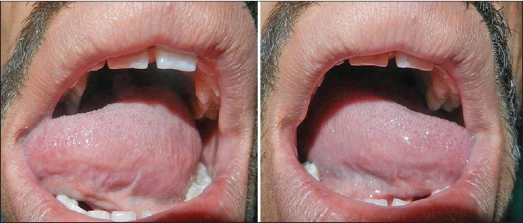 Figure 10: Tongue position on left and right lateral movement after 2 years (Case 2)