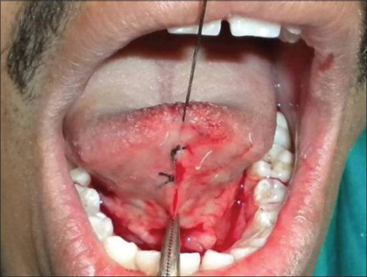 Figure 5: Presuturing prevents excessive opening of diamond shape wound (Case 2)