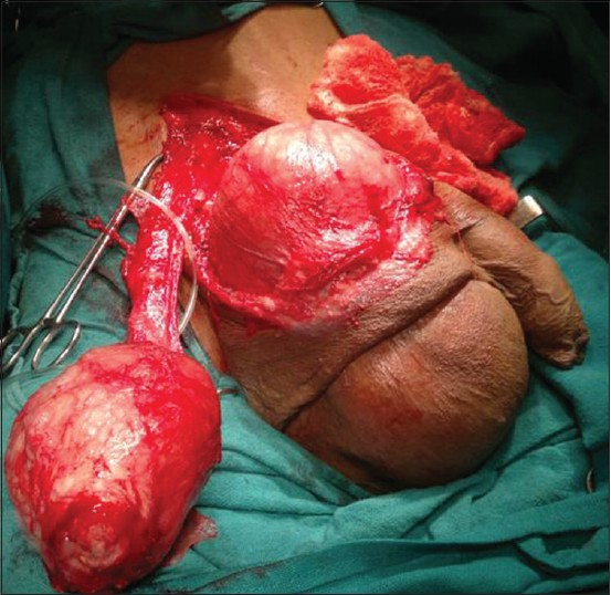 Figure 1: Separated right cord and testes, left crossed ectopic testes with pyocoele and left scrotum