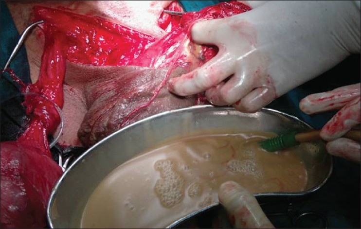 Figure 3: Fluid material [pus] drains out from pyocoele sac