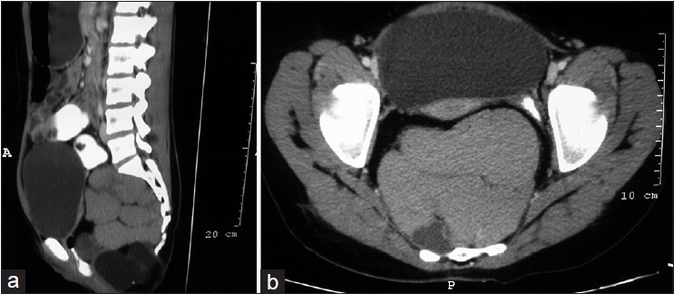Figure 1 (a and b): CECT abdomen showing multiseptated pre sacral mass compressing the rectum and displacing bladder superiorly